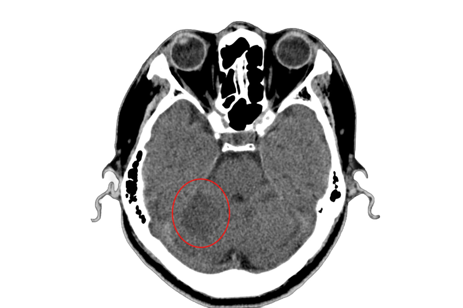 ISCHEMIC STROKE CARDIOVASCULAR DISEASE visual data 5
